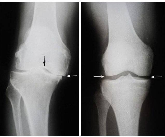 Jointerra tratament articulații - imagine ilustrativă